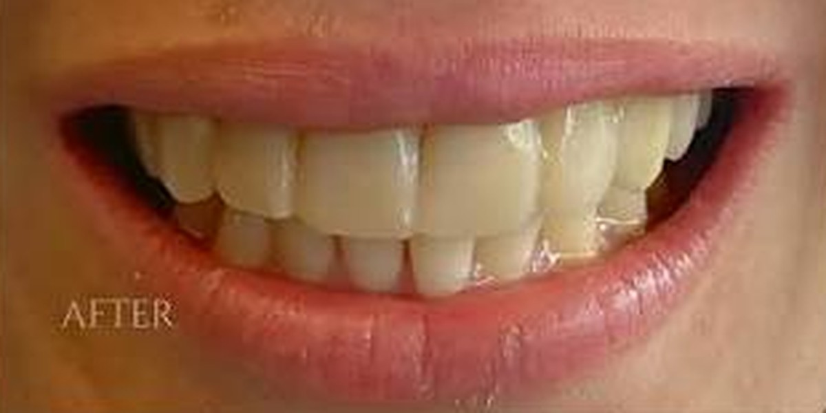 Crowns due to enamel hyperplasia, after