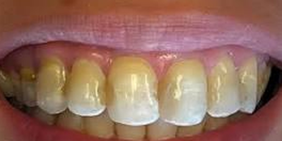 Crowns due to enamel hyperplasia, before