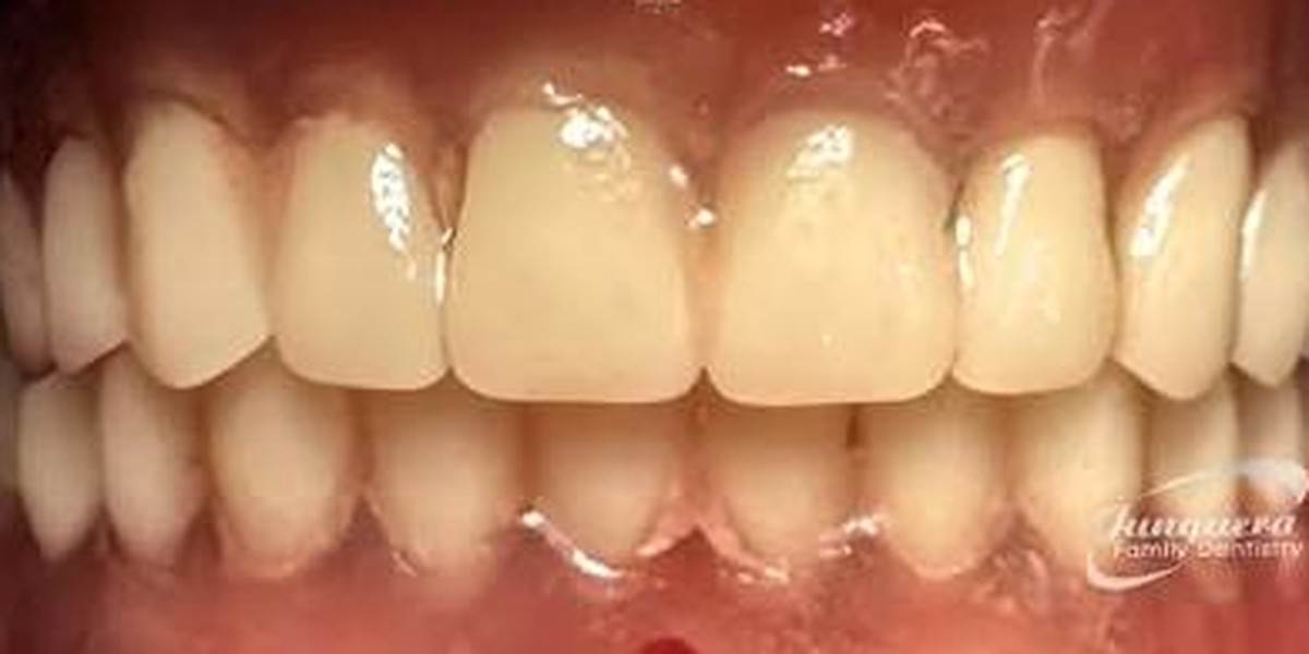 A full smile rebuilt, after