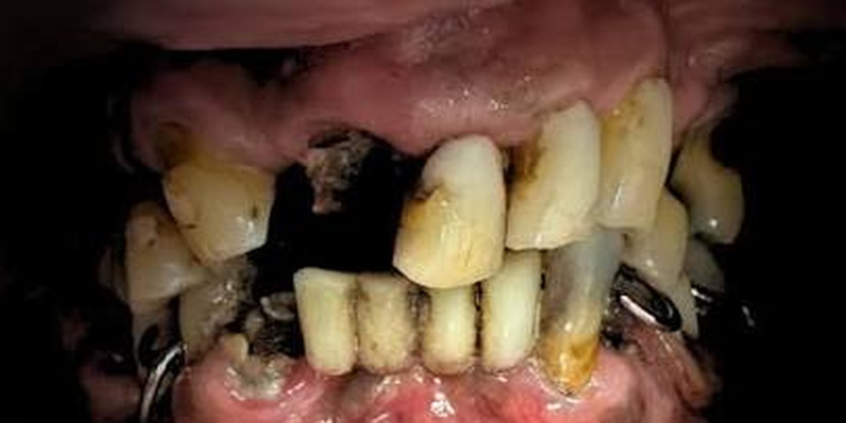 A full smile rebuilt, before