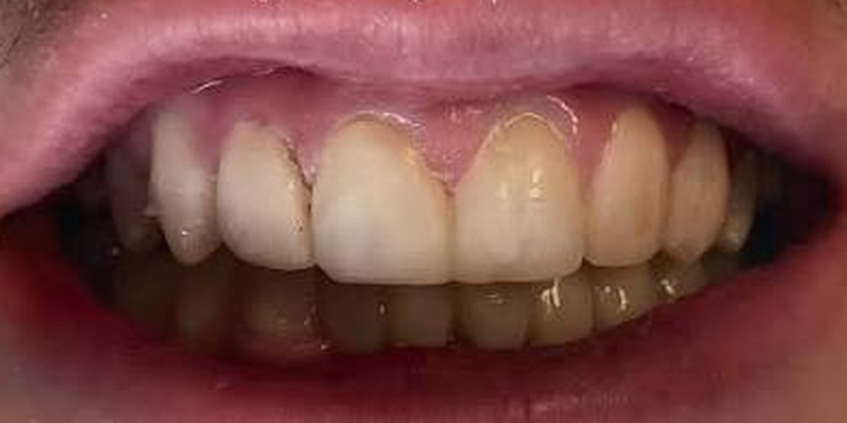 A gap and broken edges restored, after