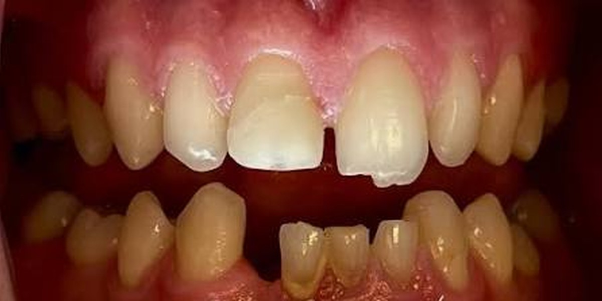 A gap and broken edges restored, before